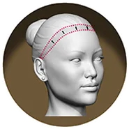 forehead-reconstruction