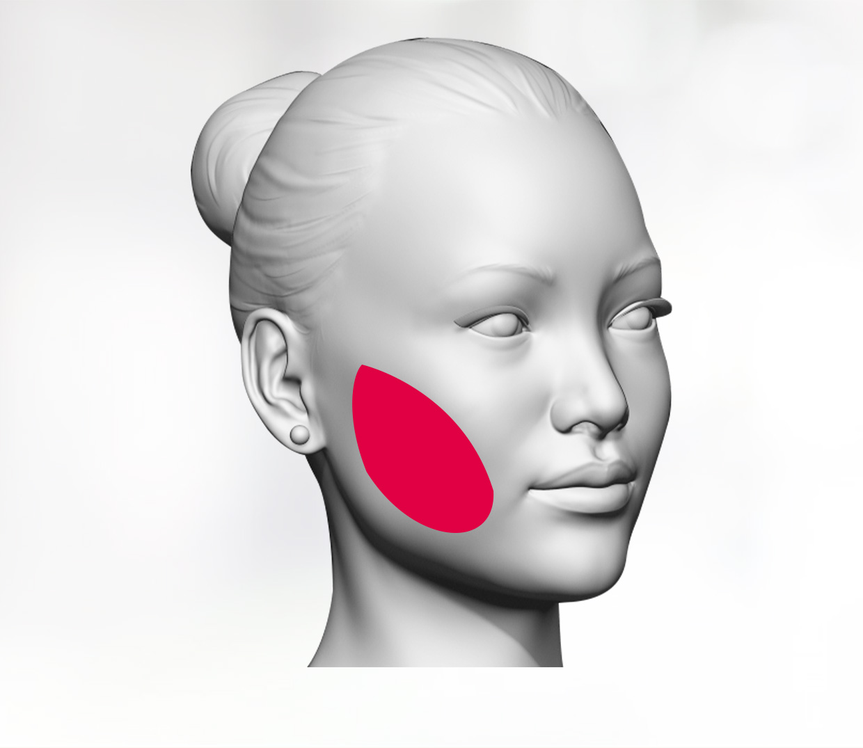 Cheek augmentation with fat or implants