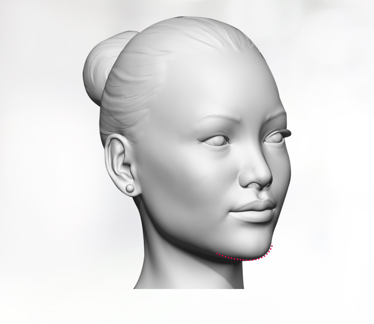 Genioplasty/chin reduction in India