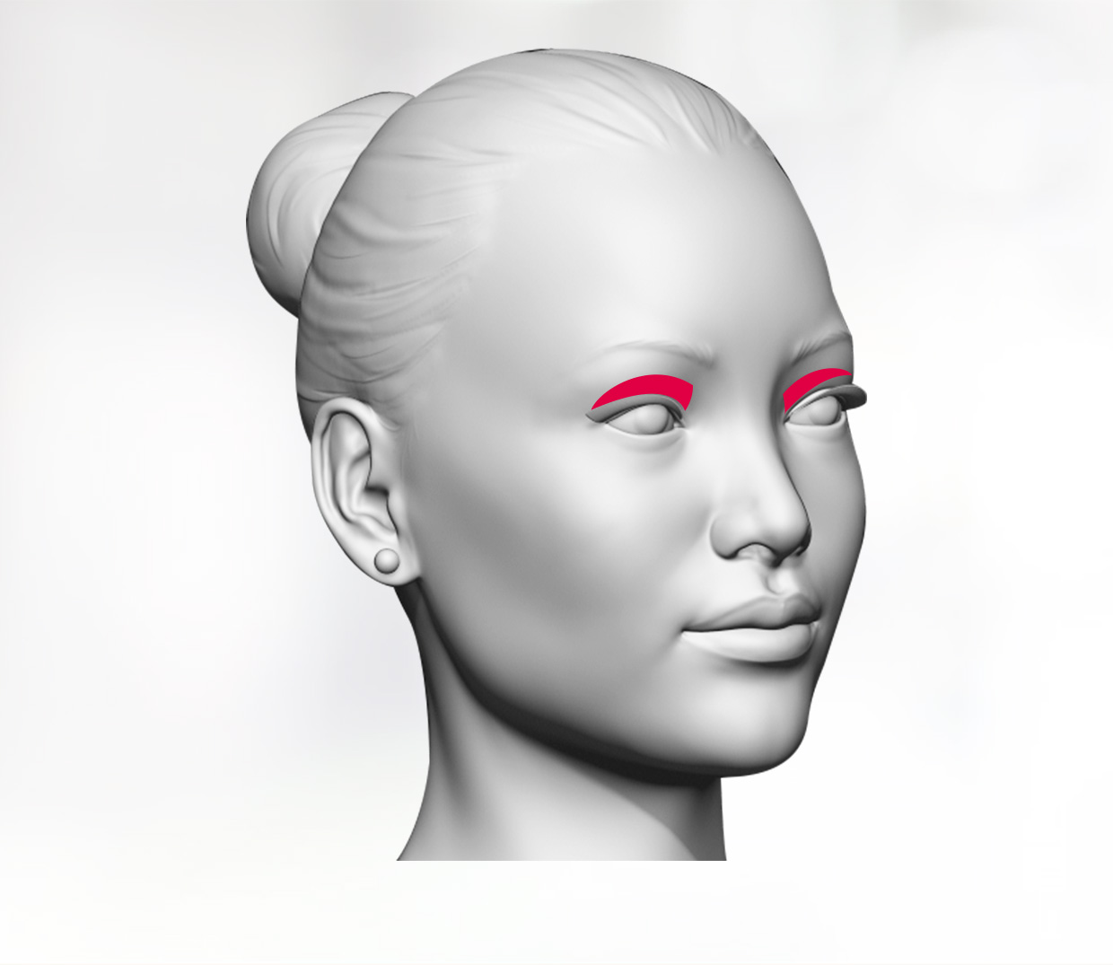 Blepharoplasty for eyelid contouring