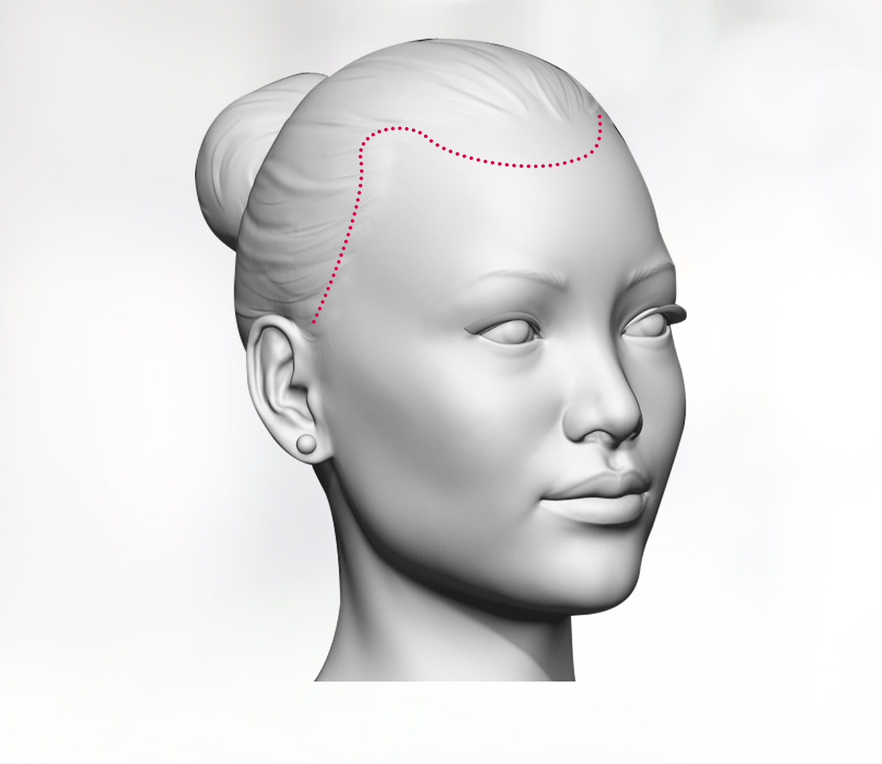 Hairline Advancement
