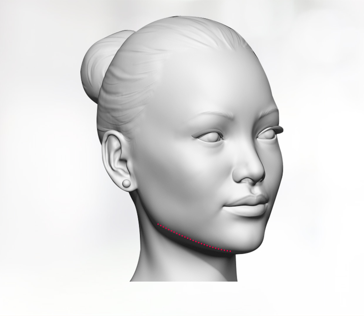 V-line jaw shave